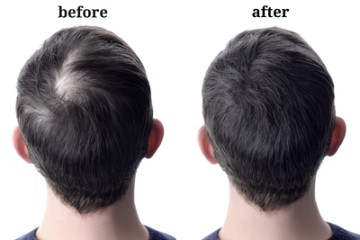 Hair Loss Restoration
